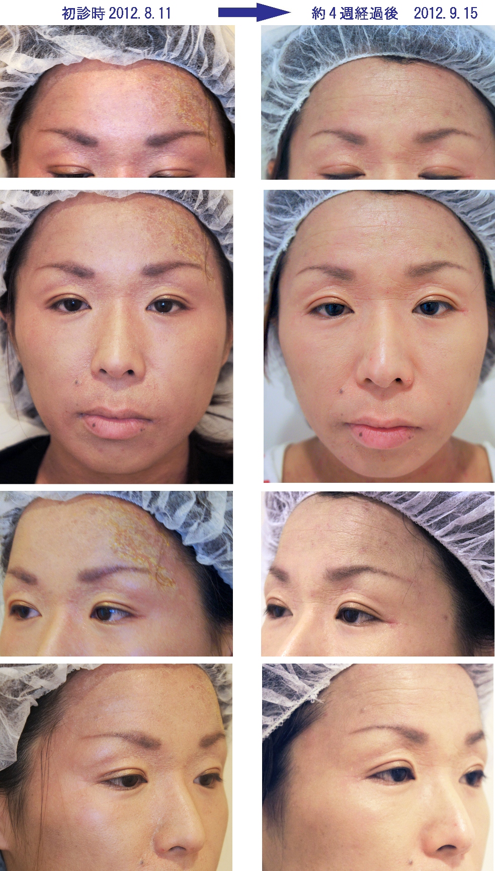 アトピー性皮膚炎？？？ 湿潤療法- 粉瘤 アテロームこおりたひろ整形形成外科クリニック - 痛みの少ない粉瘤治療で多数の実績大阪