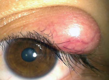 麦粒腫 ものもらい ・霰粒腫 - 台東区蔵前 クラマエ眼科 公式 一般眼科