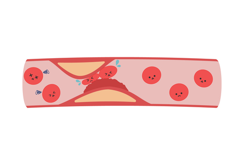 血液・血圧・血管の関係図解。動脈硬化・心筋梗塞・狭心症の研修資料用フリー素材介護看護リハビリのフリー素材集