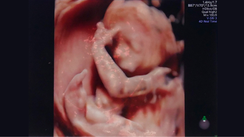 ダウン症の顔の特徴 その他外見の特徴全て 足・耳・手等々Down and UP