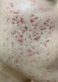 ほうれい線 気になりますか ❓️😳 実はほうれい線は子供のころからあるもので 年を取るにつれ頬がたるんでくることで ほうれい線が深く定着してしまいます💦💦そして特に口が前に出ていて頬骨が大きい 東アジアの骨格的にもほうれい線が出来やすい とのことです