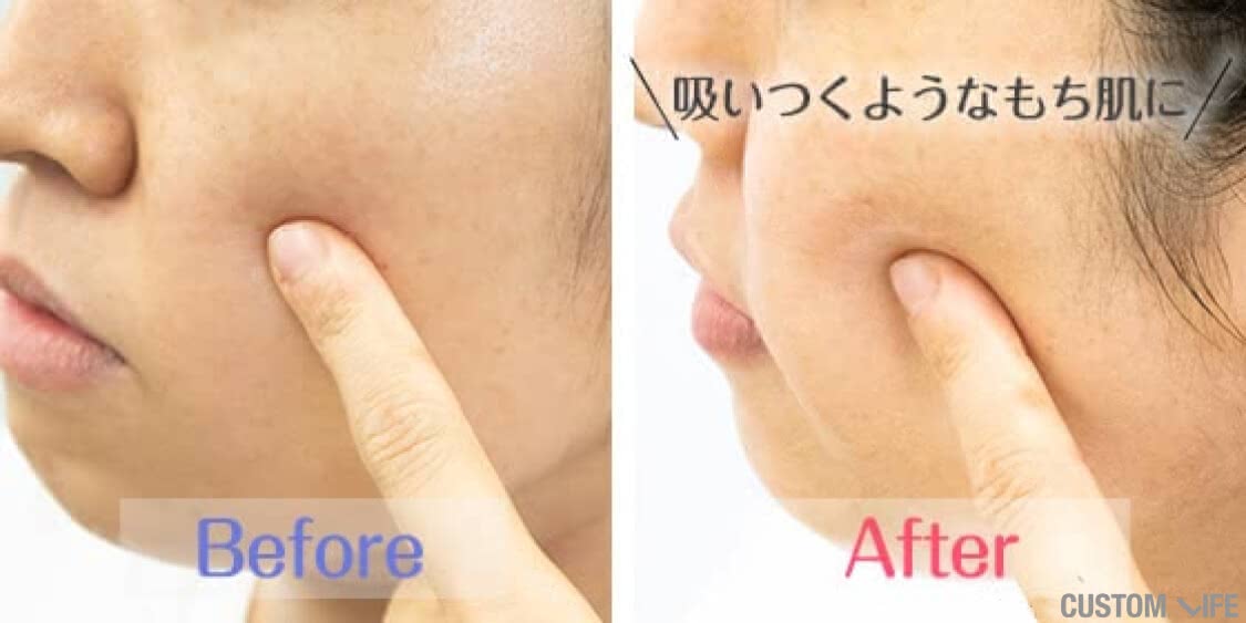 ニキビ痕の赤みが気になる！どうしたらいいの？？ - かすがい皮膚科豊田市の皮膚科・美容皮膚科