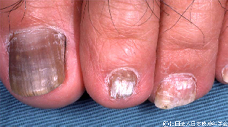 爪に起きる病気・症状について東京巻き爪矯正院練馬院