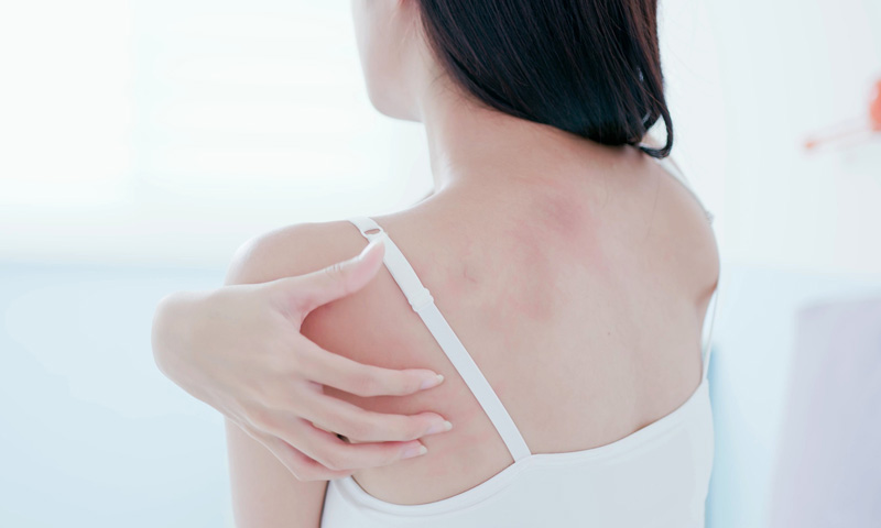 背中ニキビ 身体ニキビ の原因はカビ？マラセチア毛包炎の症状や治療方法について肌トラブルとスキンケア持田ヘルスケア株式会社