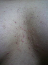 繰り返すニキビ、ニキビ跡～その種類と原因、治療法とは～横浜市鶴見の形成・美容外科 エムズクリニック