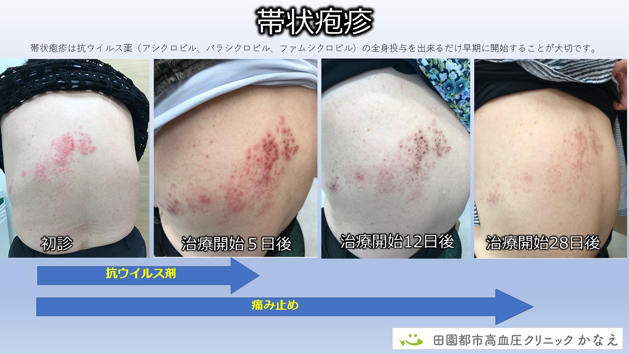 帯状疱疹と神経痛の関連Horikawa Chiropractic