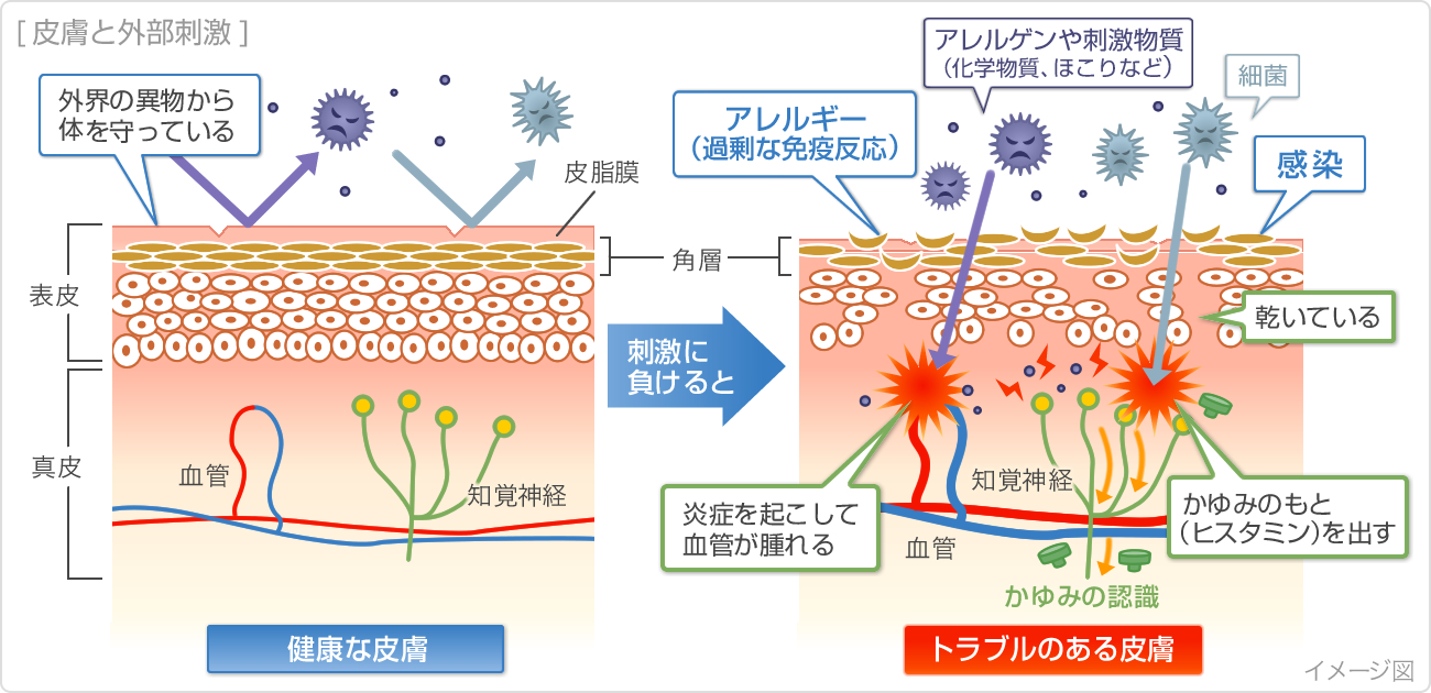 ストレスが原因となる皮膚トラブル薬局・薬店で相談できる皮膚トラブルヒフシルワカル