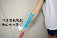 スポーツ傷害・捻挫・肉離れ・靭帯損傷 - 手稲区の整骨院。腰痛・肩こり・頭痛からむち打ちまで、各種保険適用で安心治療