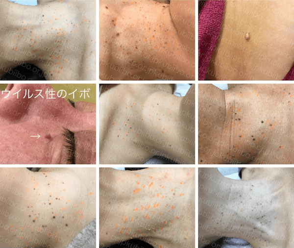 首のイボの治療てしまクリニック 形成外科・皮膚科 文京区 後楽園 春日