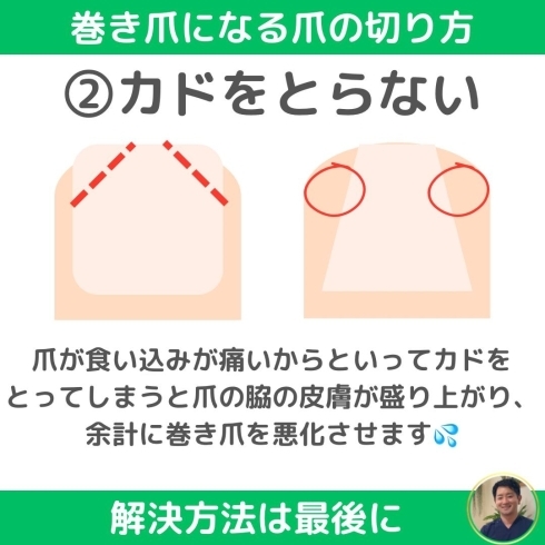 巻き爪切り方・ニッパー使い方を画像で解説大田区大森・大木皮膚科