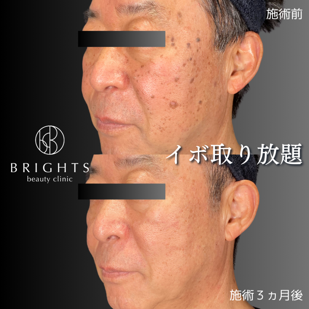 炎症後色素沈着とは？シミが治る期間や跡が残りやすい人の特徴を知ろうハダメディア by BIHADADO.TOKYO