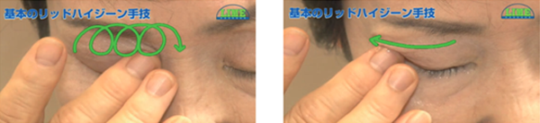 霰粒腫 ものもらい まぶたに関わる治療東京都 八王子市の霰粒腫 ものもらい の治療なら八王子友愛眼科へ