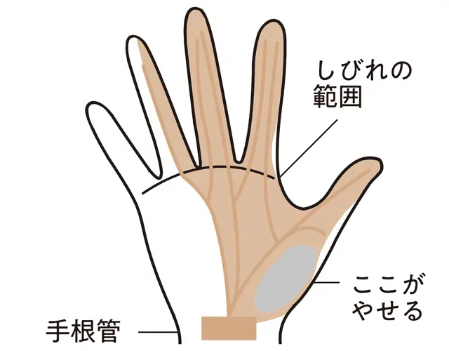 指のむくみで曲げにくい 」原因は関節リウマチ？ばね指？病院に行く目安もMedicalook メディカルック