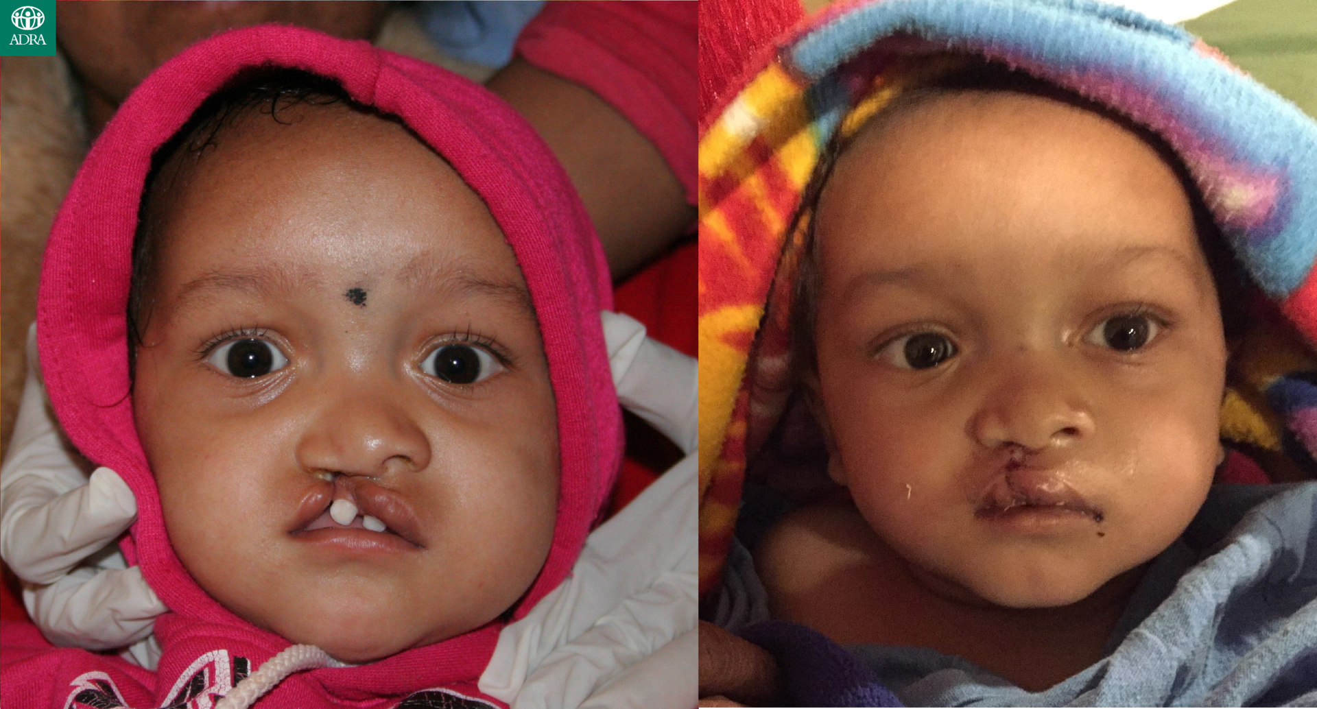 口唇口蓋裂藤田医科大学病院 形成外科