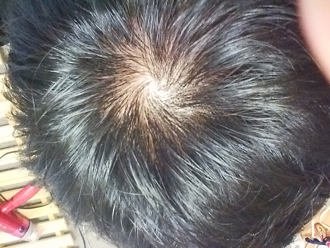 つむじorはげ -男子中学生です。このつむじははげていますか？-OKWAVE