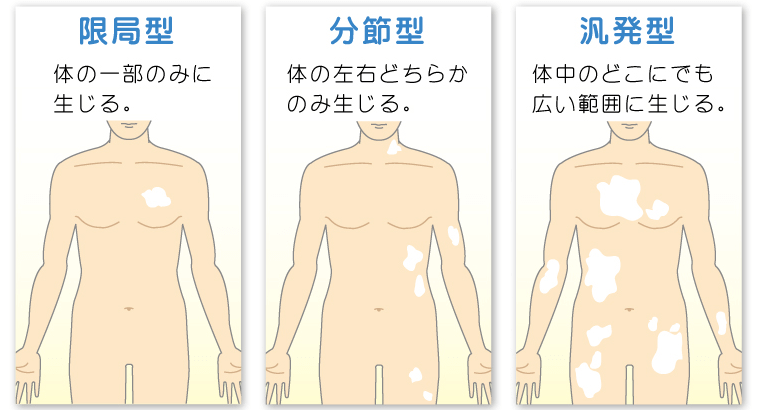 白斑埼玉県皮膚科医会