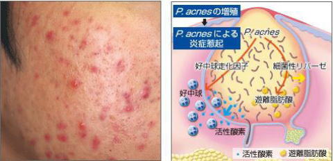 円形脱毛症・男性型脱毛症の原因と治療法は？神戸市須磨区の大塚皮フ科クリニック