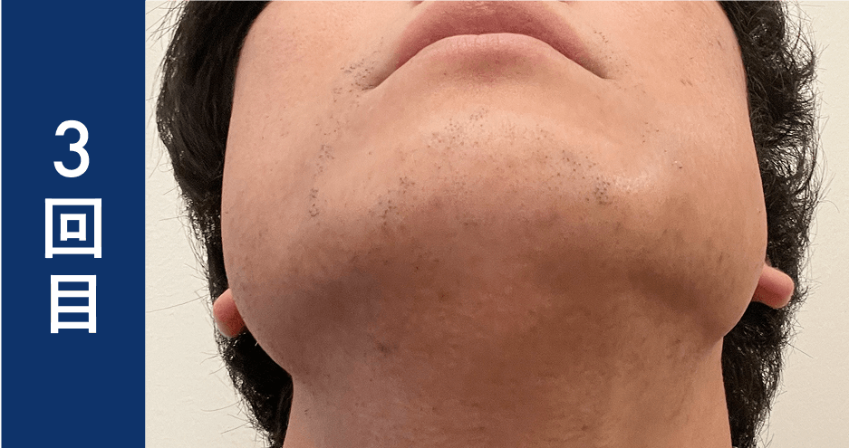 2025年最新 石川県で人気のヒゲ脱毛おすすめサロン10選Midashinami 身だしなみ