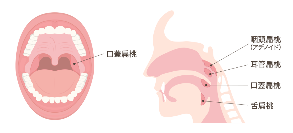 扁桃炎とは？扁桃腺が腫れてる とはどういう意味？つばさ在宅クリニック西船橋 船橋市の内科外来と訪問診療