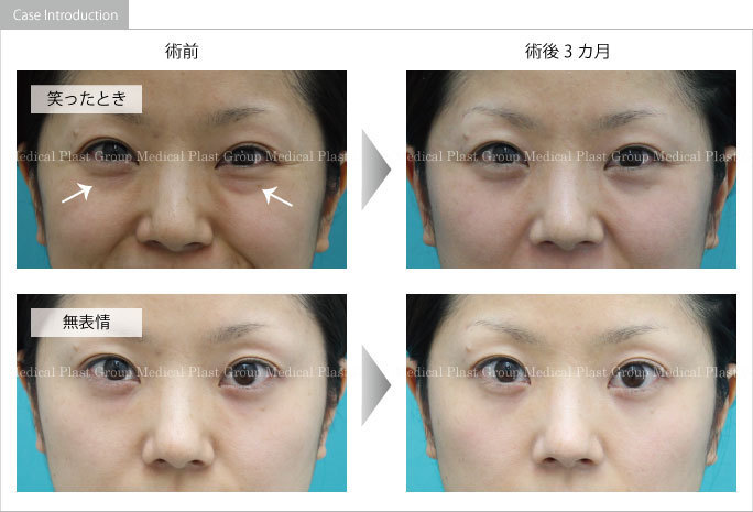 医師監修 目尻のシワの原因は？ケア方法や治療法を紹介美容医療のかかりつけ医 わたしの名医