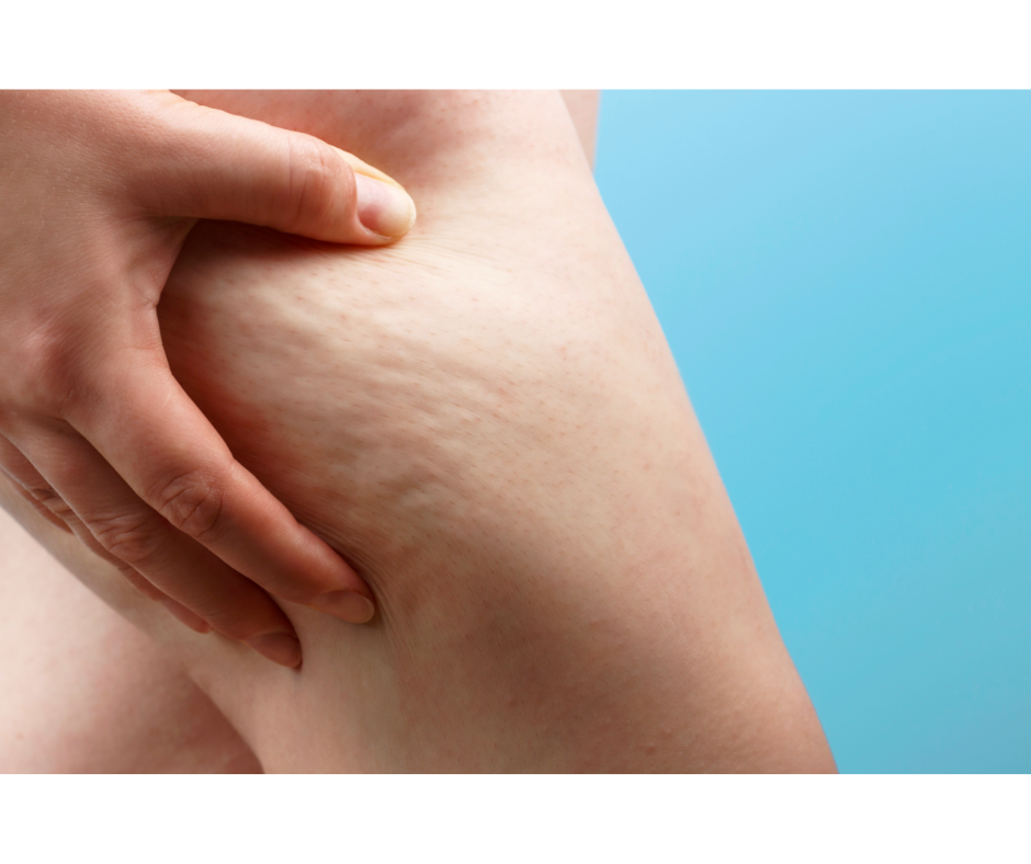 マッサージガンのセルライトへの効果を調査！使い方のポイントも解説セルライトのススメ