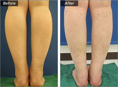 下肢静脈瘤の手術後、足の症状と見た目はどうなる？生活面での注意点は？下肢静脈瘤の原因・症状・治療方法・予防方法などを専門医が解説