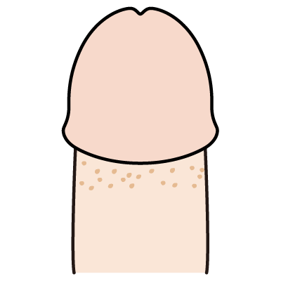 できもの 良性腫瘍すがも小林皮フ科