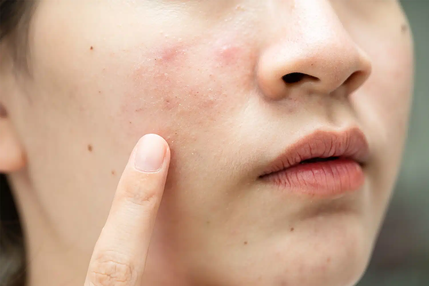 首ニキビの原因と治し方は？首の後ろやフェイスラインなど部位別の原因と効果的な治療薬を解説ハダメディア by BIHADADO.TOKYO