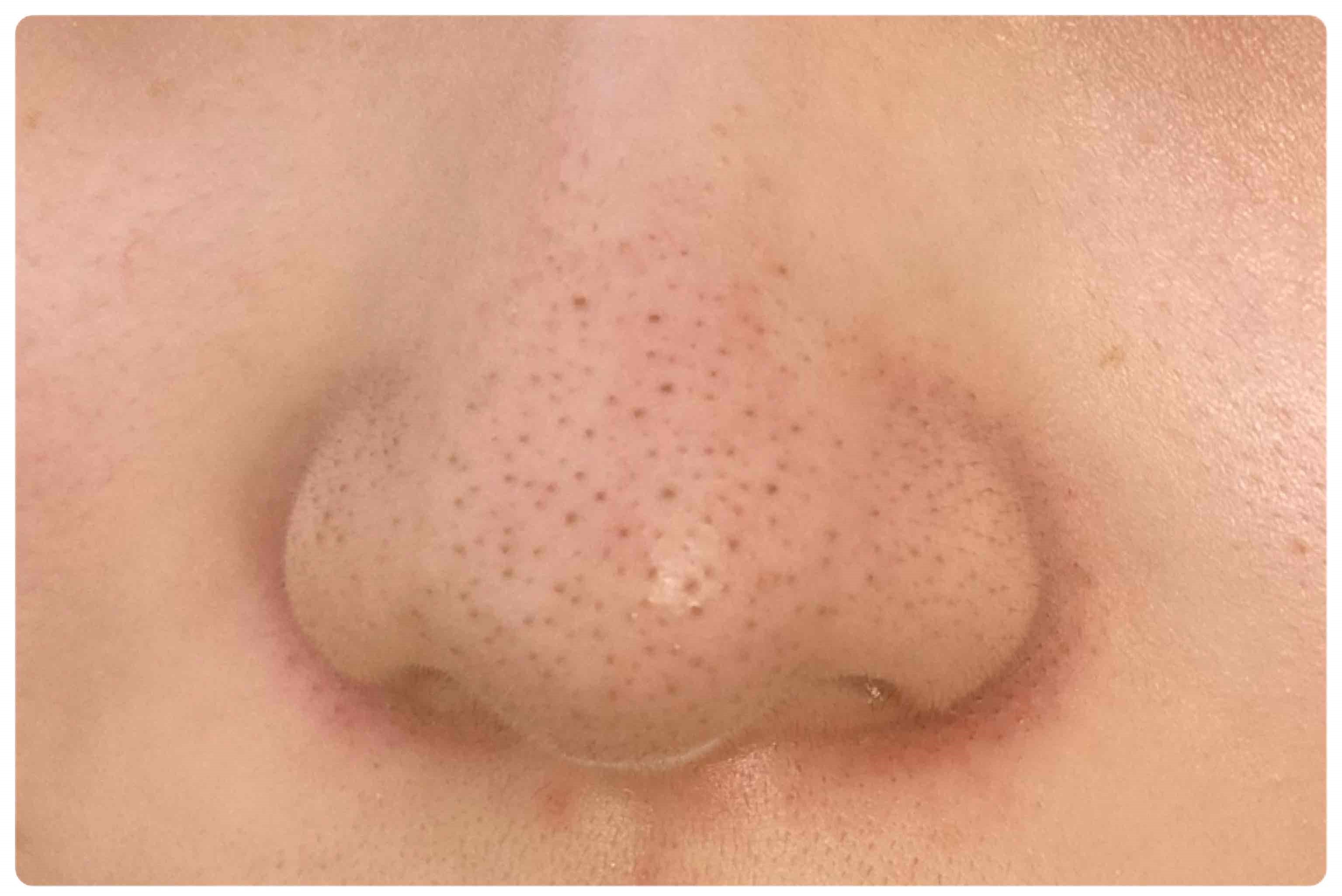 イチゴ鼻の治し方◎神戸市東灘区エステコラム東灘・住吉駅のサロンドエルサ