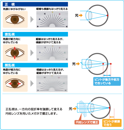トーリック眼内レンズ乱視軽減眼内レンズくりっくeye