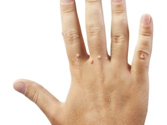 首イボ治療のご相談なら池袋駅前のだ皮膚科へ首、まぶた、わきにできる肌色や茶色のポツポツ アクロコルドン、スキンタグ の症状と治療について