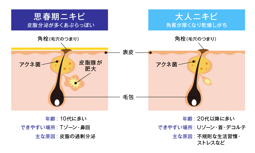 フケ症 脂漏性皮膚炎 吹田市の皮膚科もりはら皮ふ科クリニック