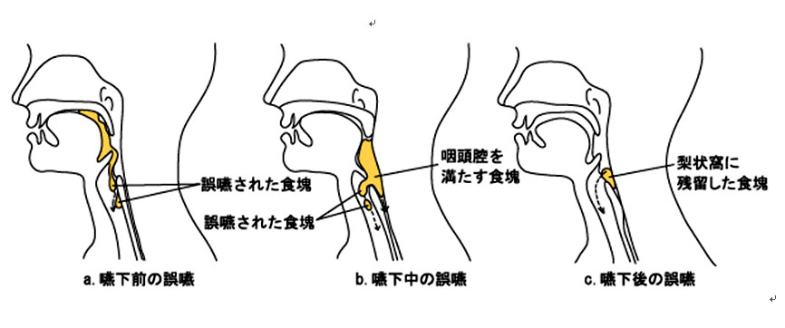 脳科学から見た双極性障害すまいるナビゲーター大塚製薬
