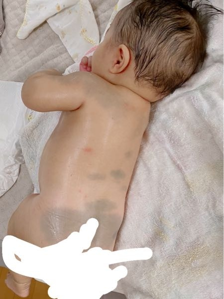 異所性蒙古斑 形成外科へ初受診いぷりぐの Que sera sera 気まぐれ日記