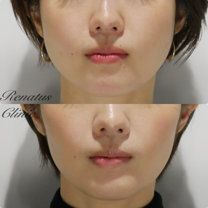 エラ取り ボトックスページ1症例写真美容整形のことなら千葉 船橋・銀座の東京形成美容外科・美容皮膚科