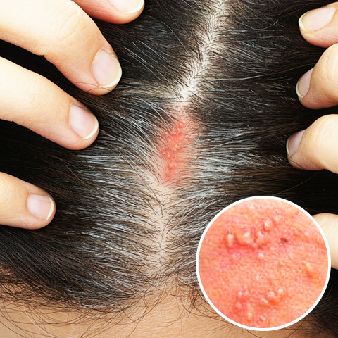 歯の中に『膿袋』！中でばい菌が大量繁殖した結果