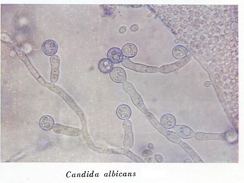 口腔カンジダ症口内に生じる経口ツグミ。口腔粘膜上の真菌カンジダ菌の真菌症 酵母感染 。」のベクター画像素材 ロイヤリティフリー1008374242Shutterstock