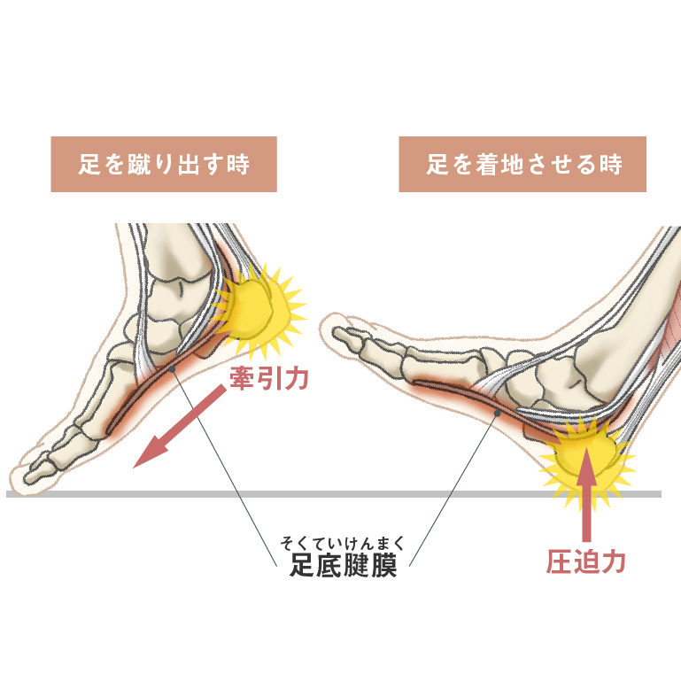 かかとが痛い原因はシーバー病のせい? 痛みの原因や対処法を解説サカイク