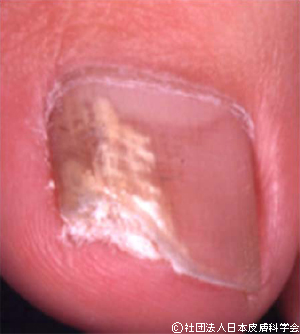 水虫はうつる？皮膚科で適切な治療を受けましょう墨田区の曳舟泌尿器・皮ふ科クリニック