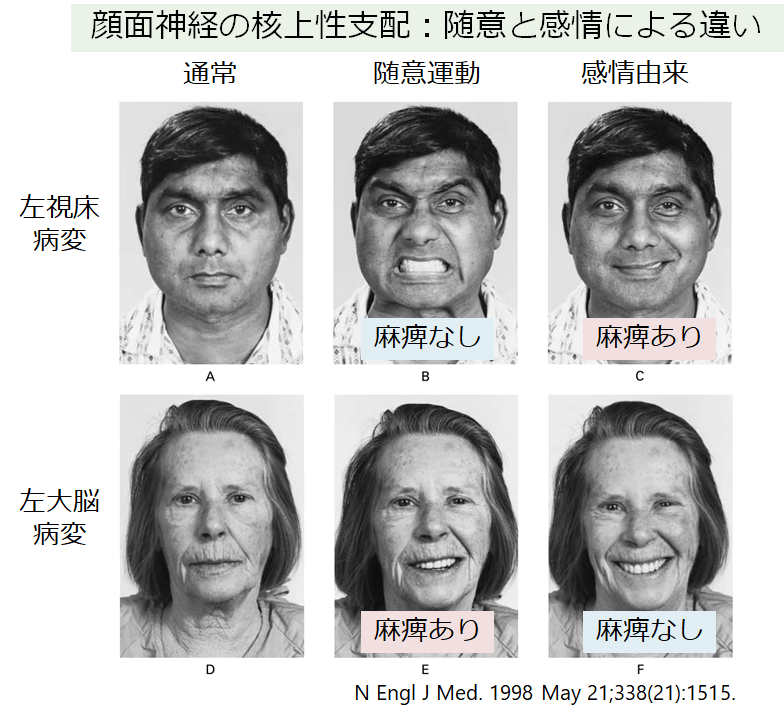 脳卒中の初期症状脳神経外科札幌白石記念病院