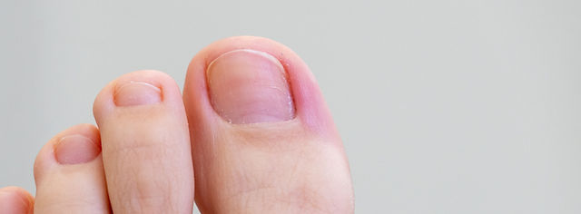 爪の病気の写真素材写真素材なら「写真AC」無料 フリー ダウンロードOK