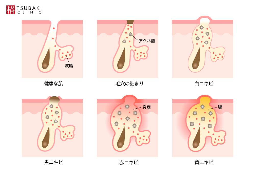 顎のザラザラを治す2つの方法ピーリングや洗顔で角栓除去「なめらか肌」へ健康肌スキンケア