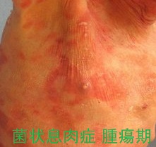 画像でみる皮膚の悪性リンパ腫 菌状息肉症など の症状と分類メディカルノート