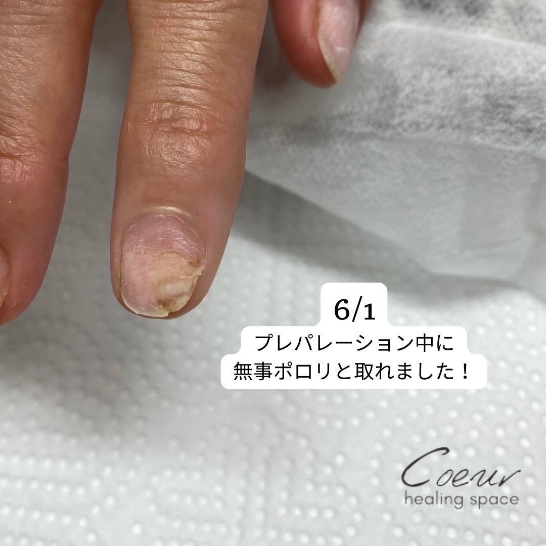 ドアで挟んで内出血した指のその後 ´ε｀；アラフィフyuuのＤＩＹとたまの美と健康 ✿˘艸˘✿