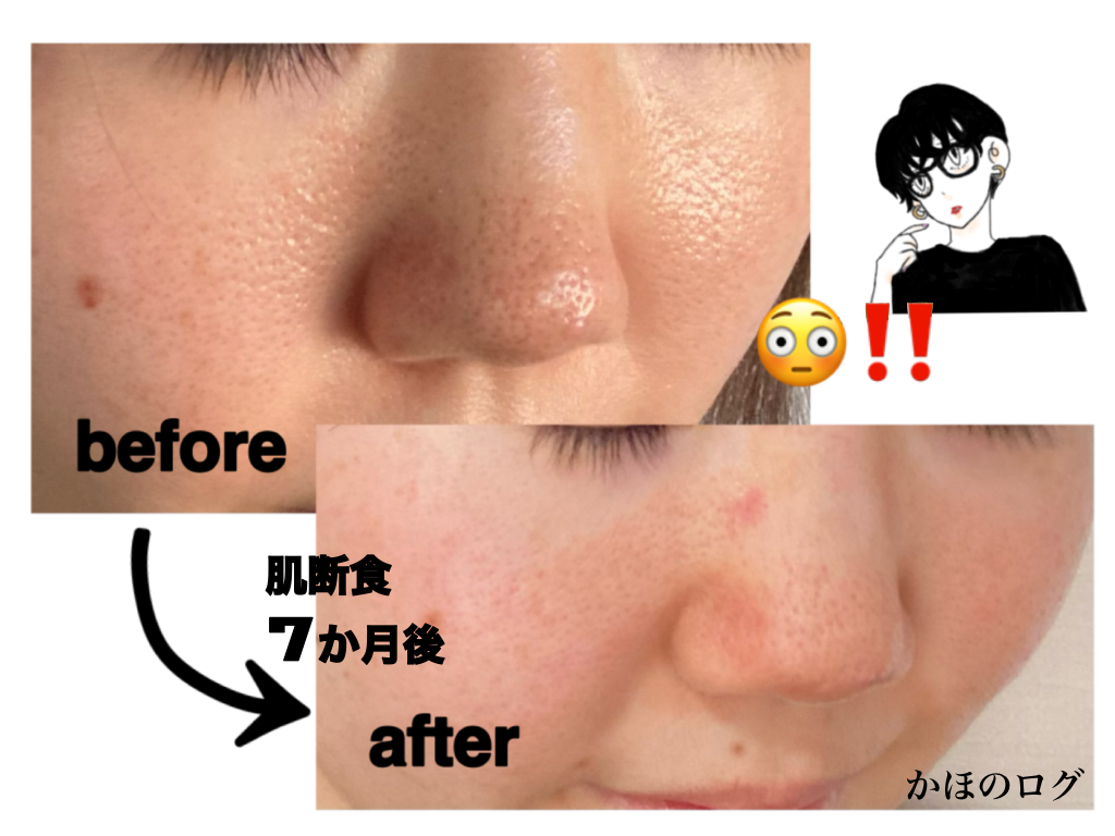 カウブランド無添加・シャボン玉石けん・サンホワイトのボディケア・オーラルケアを使った口コミ -頑固ないちご鼻改善🧐 肌断食４ヶ月目 byえび 混合肌 20代後半LIPS