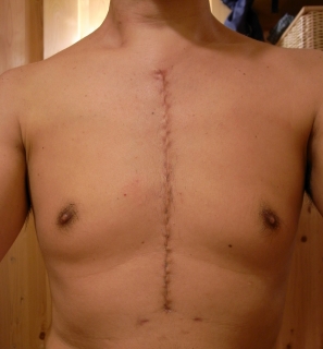 傷が目立たない小切開心臓手術 MICS について教えてください病気と治療の検索サイト「メディカルブレイン」