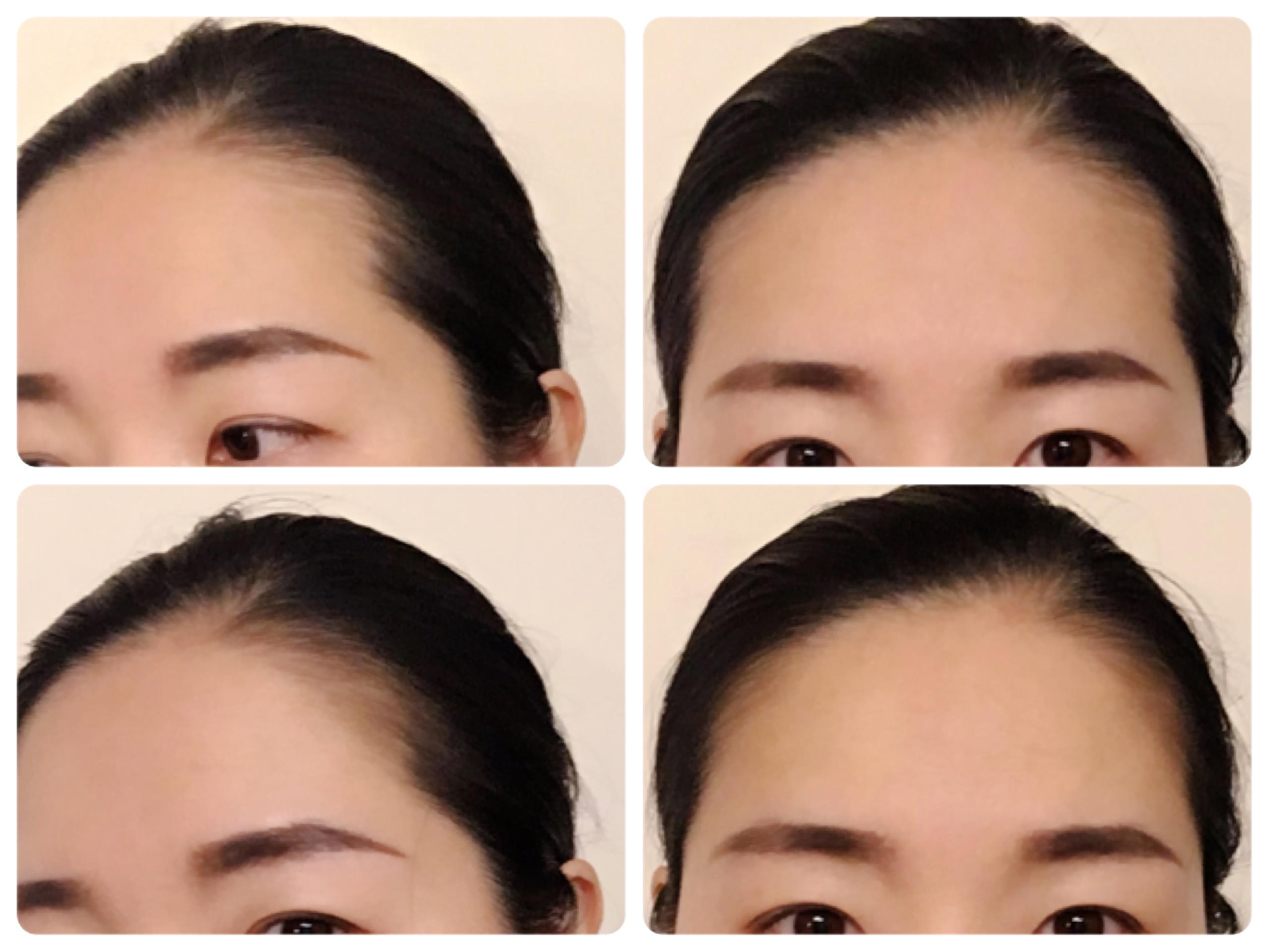 富士額とは？似合う髪型や気になる悩みの解決方法を紹介 - HealthHair Lab ヘルスヘアラボ