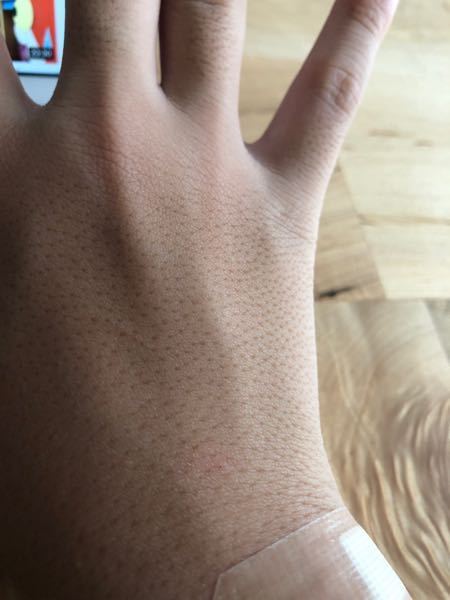 手の甲の毛穴が目立って困っています。こんにちは。中2の女子です。- Yahoo!知恵袋