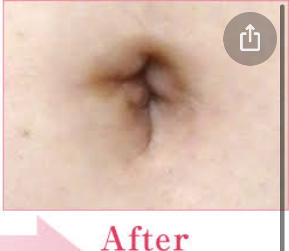 へそ形成リンク美容外科韓国美容整形ツアーへそ整形 縦長韓国へそ整形へそ整形 費用