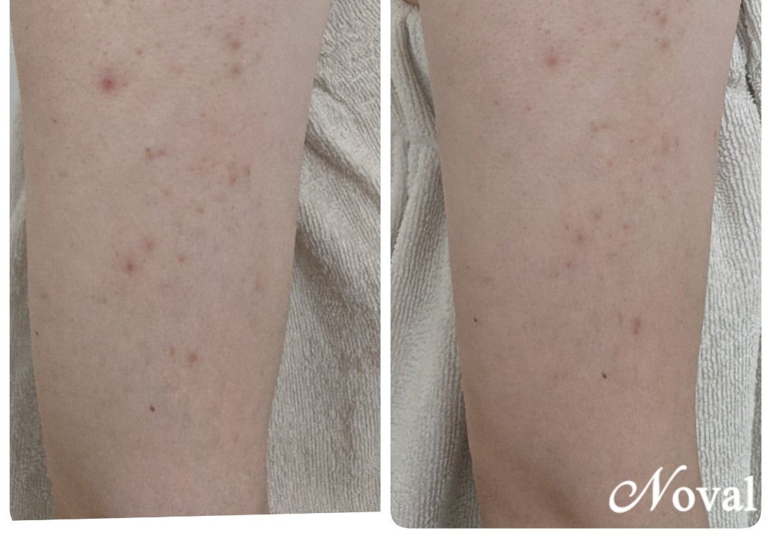 大阪で毛孔性苔癬 もうこうせいたいせん ・毛孔性角化症の治療